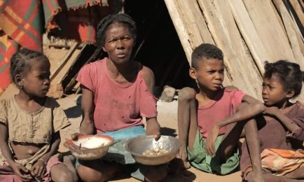 Kondisi Busung Lapar Akibat Kekurangan Gizi