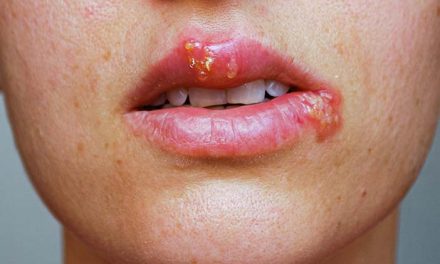 Penyakit Menular Seksual Atau Sifilis