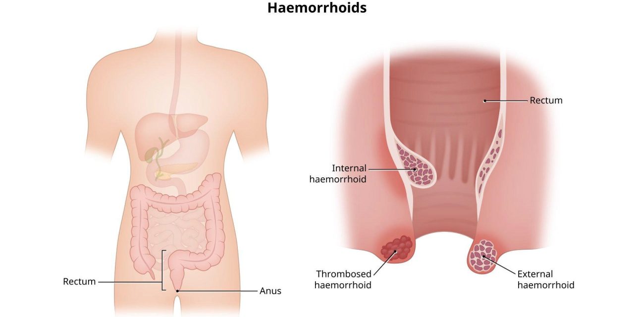 Wasir Balik Lagi? Mungkin Gara-Gara Kebiasaan Ini!