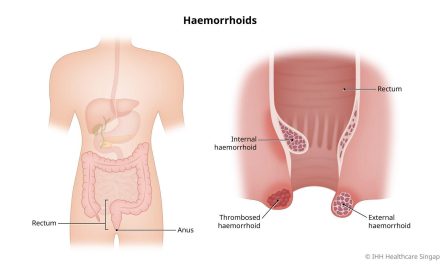 Wasir Balik Lagi? Mungkin Gara-Gara Kebiasaan Ini!