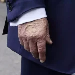 Donald Trump Idap Insufisiensi Vena Kronis