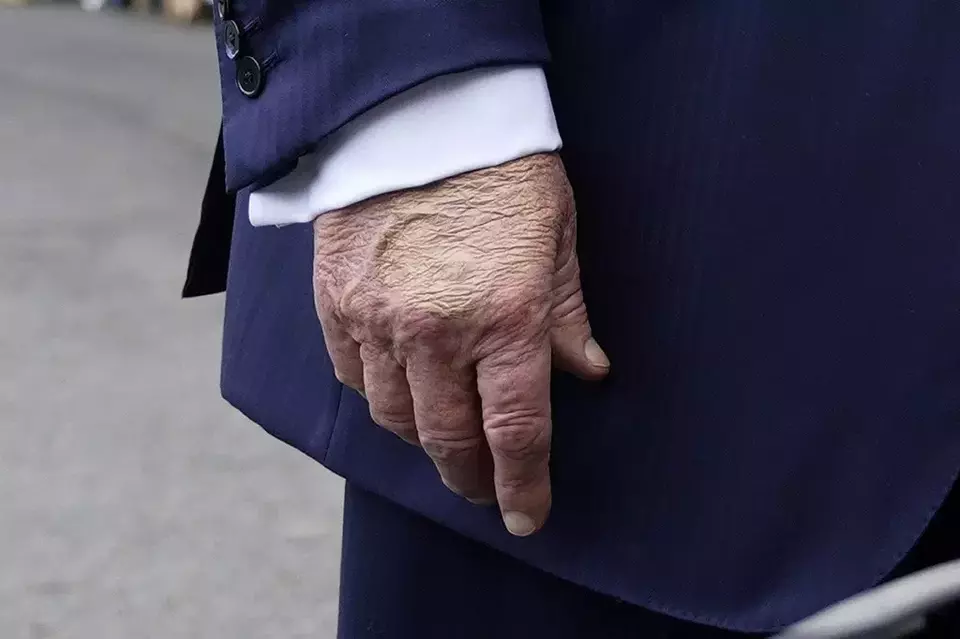 Donald Trump Idap Insufisiensi Vena Kronis